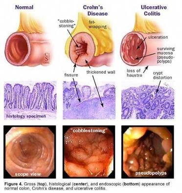 Chronic Arduous diseases - Ulcerative Colitis, Visit Sure Cure