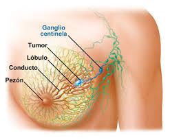 Breast Cancer -  See Achievement 8