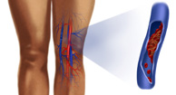 Deep Vein Thrombosis