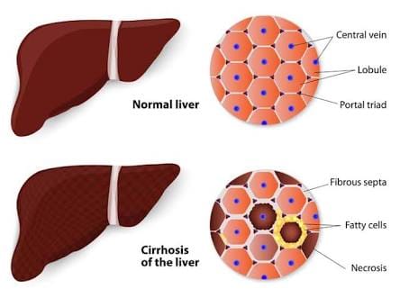 Cirrhosis