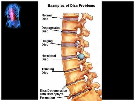 Disc Problems
