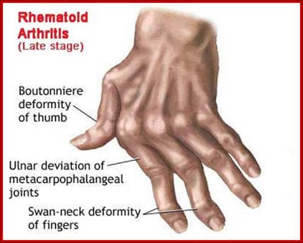 Permanently Incurable diseases - See Achievement 7 - Auto immune diseases